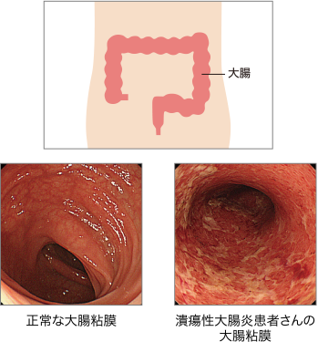 潰瘍性大腸炎って…