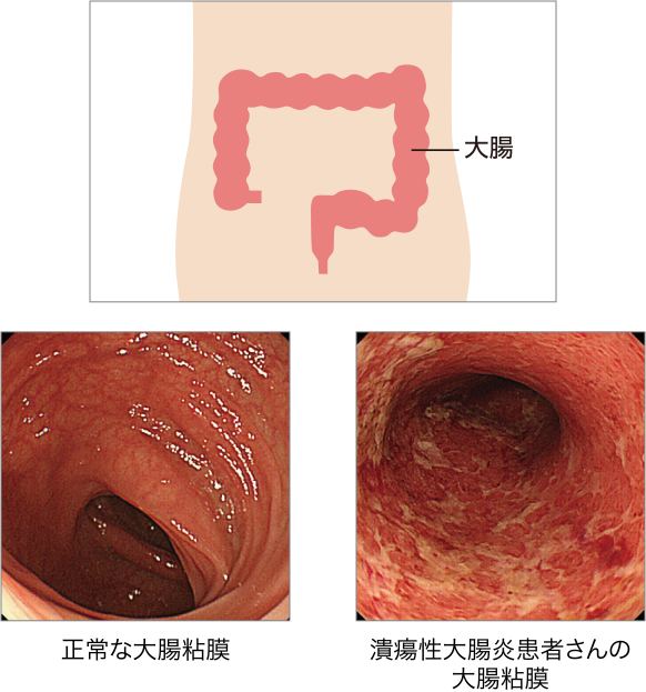 潰瘍性大腸炎って…