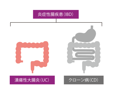 炎症性腸疾患 潰瘍性大腸炎 クローン病