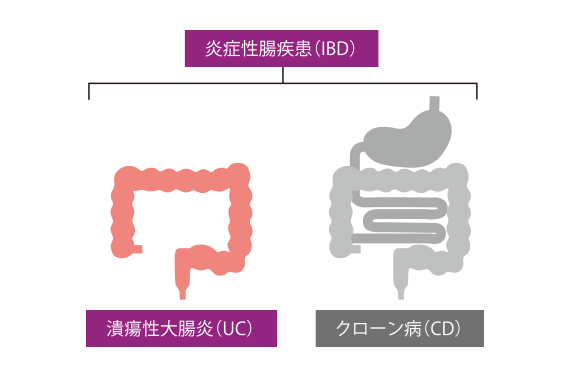 炎症性腸疾患 潰瘍性大腸炎 クローン病