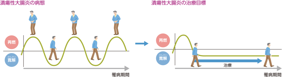 潰瘍性大腸炎の病態 潰瘍性大腸炎の治療目標