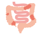 大腸型