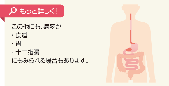 もっと詳しく！この他にも、病変が食道、胃、十二指腸にもみられる場合もあります。
