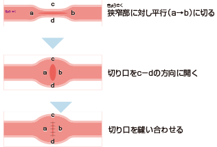 狭窄に対する手術（例）