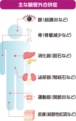潰瘍性大腸炎の主な合併症