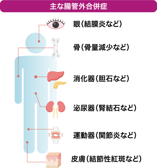 潰瘍性大腸炎の主な合併症